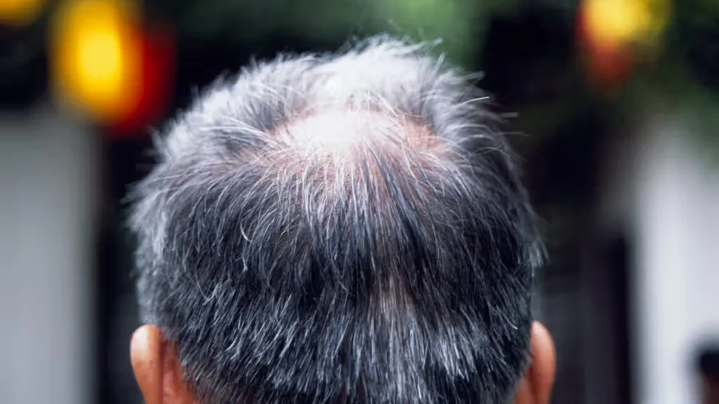 Hair Loss Solutions: What Really Works?